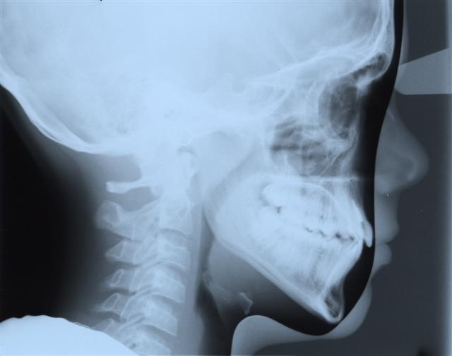 Cephalometric X-Ray