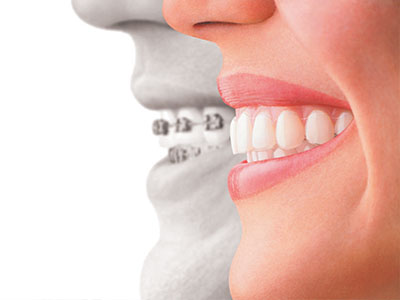 The image shows a split-screen comparison of a person s face before and after dental braces, highlighting the transformation in smile alignment and teeth straightening.