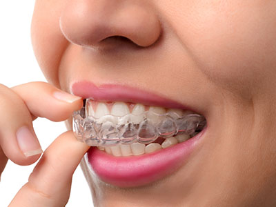 An adult woman with straight teeth and a clear complexion is seen holding her finger between her front teeth, wearing an Invisalign aligner.